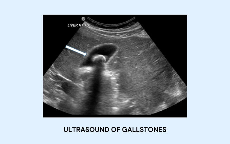 gallstone 1