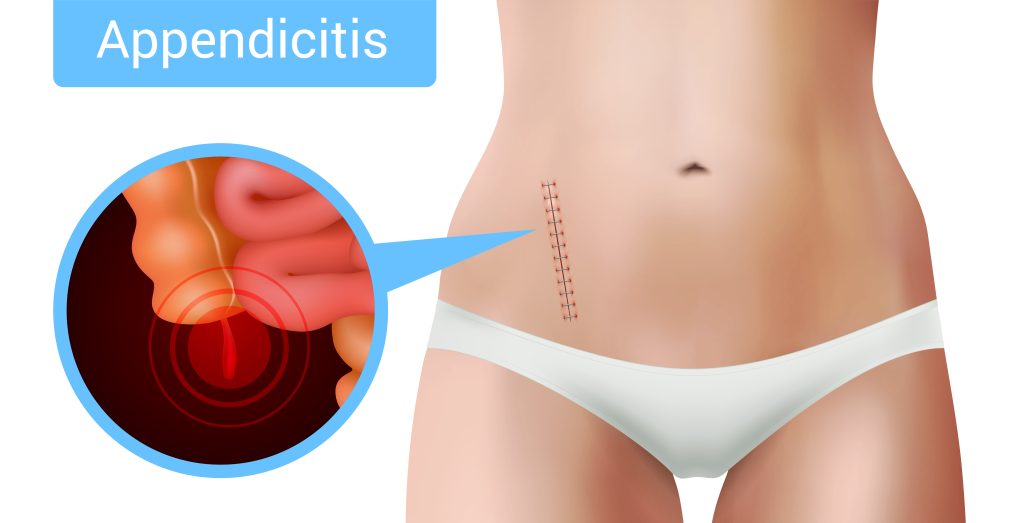 The Procedure of Appendix Operation Raja Hospital