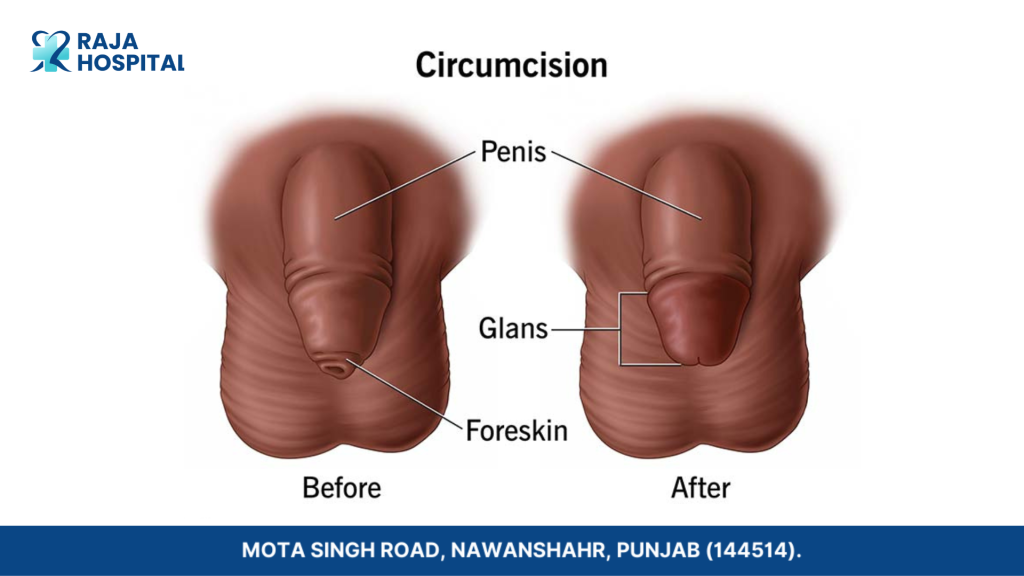 Procedure of Circumcision Surgery