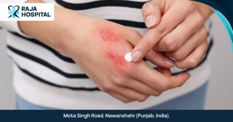 Burn Injuries in Summer: 5 First Aid Steps to Treat Them Fast!